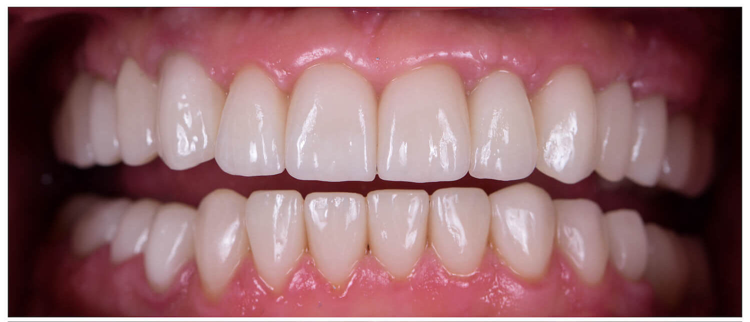 Full Mouth Rehabilitation
